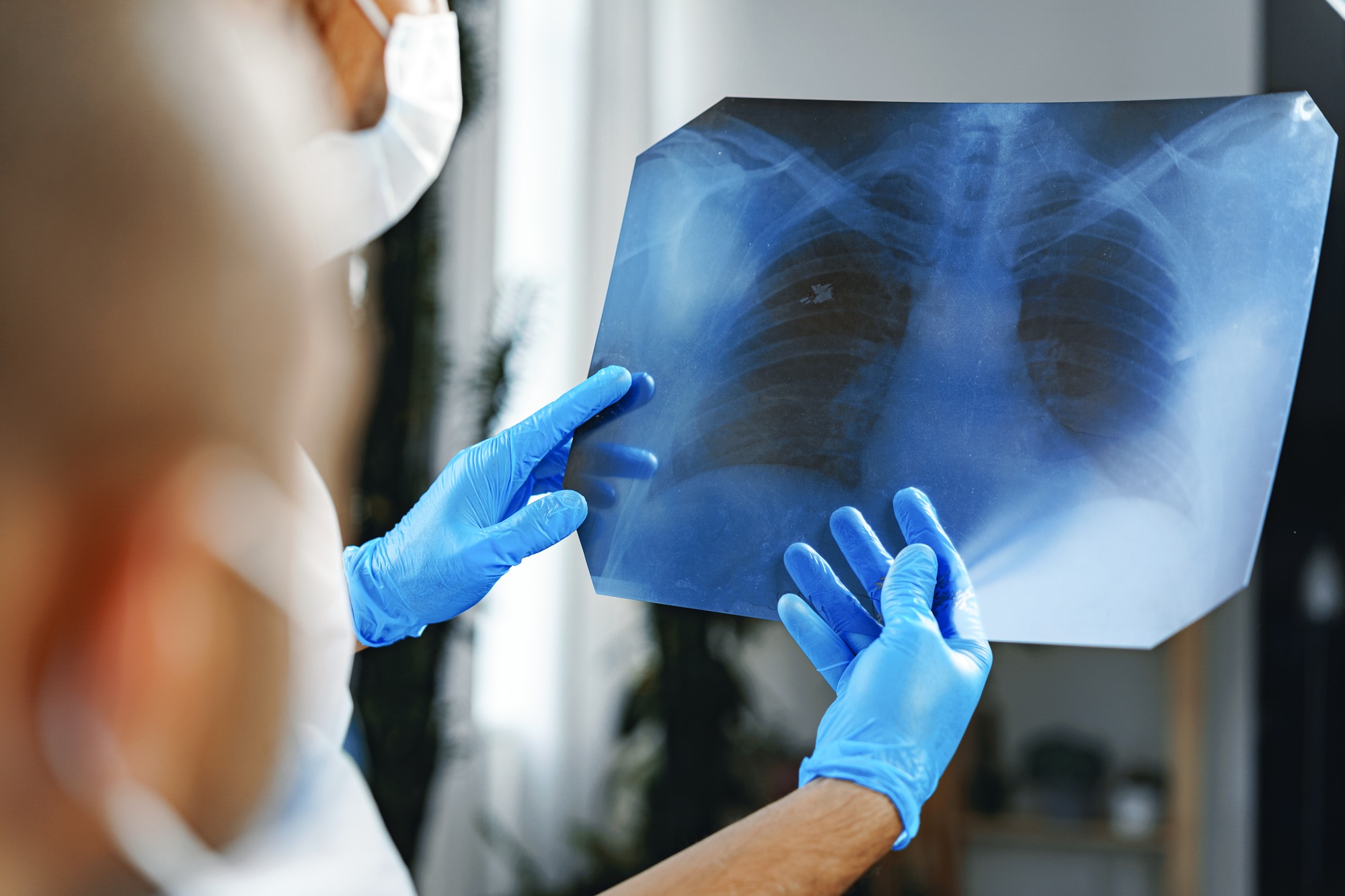 Male doctor examines an x-ray of lungs in hospital